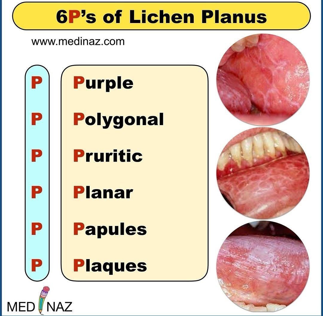 6Ps of Lichen Planus - MEDizzy