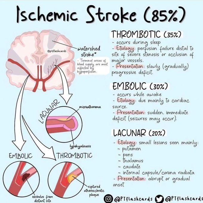 Ischemic stroke medizzy