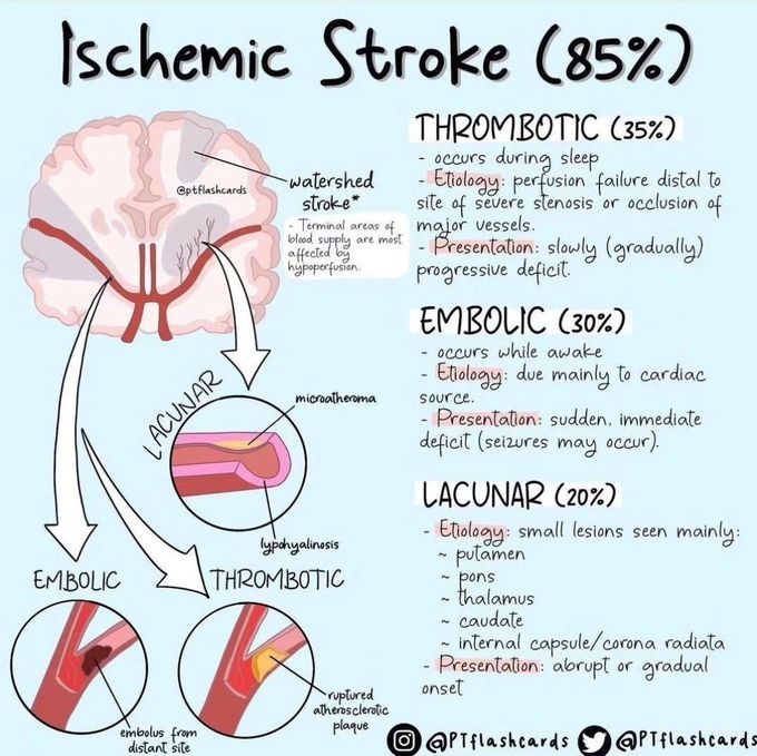 Ischemic Stroke