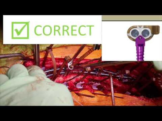 A novel growing rod technique to treat early-onset scoliosis (EOS): a step-by-step 2D surgical video