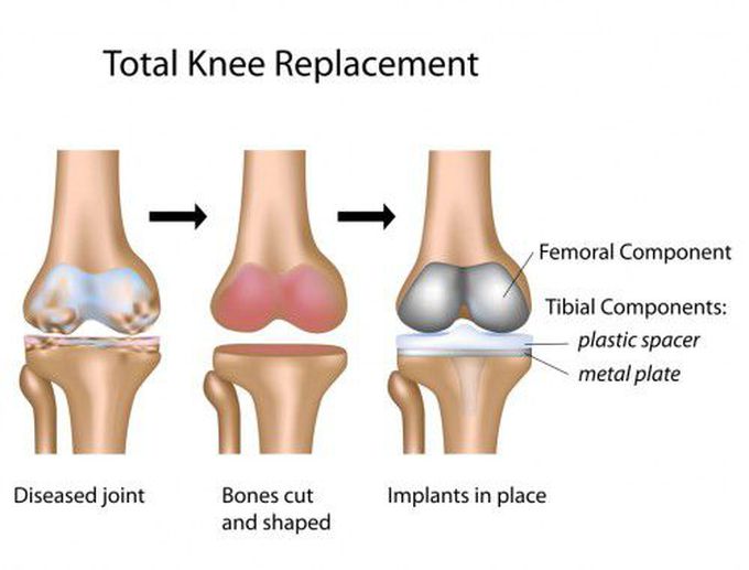 Benefits of Total Joint Replacement Surgery