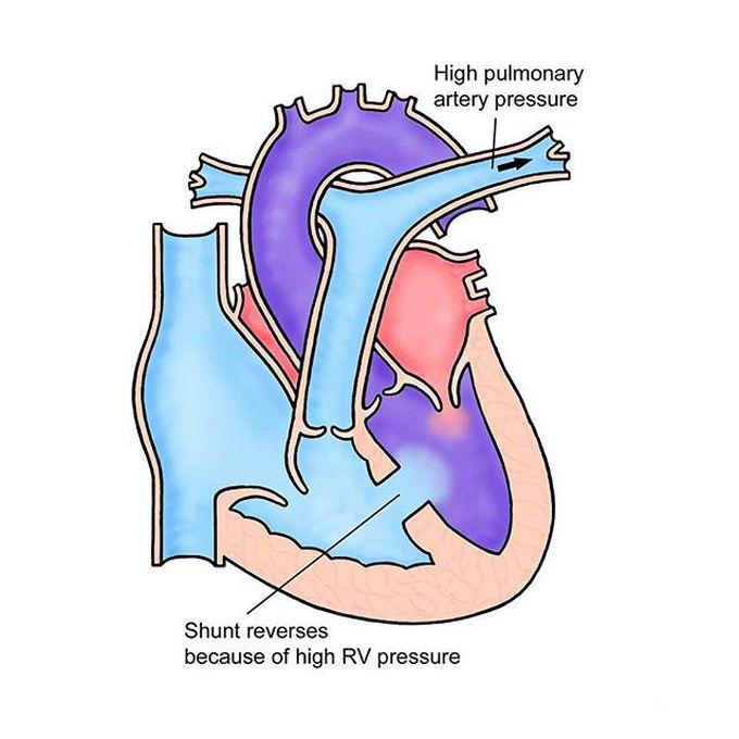 Eisenmenger's Disease