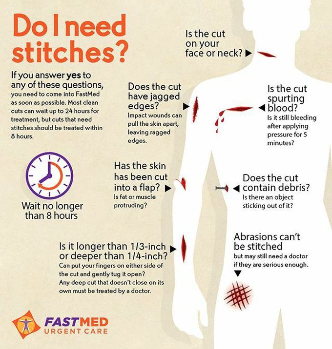 Do i need stitches