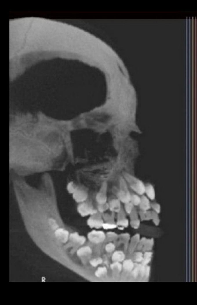 toddler skull XRAYS