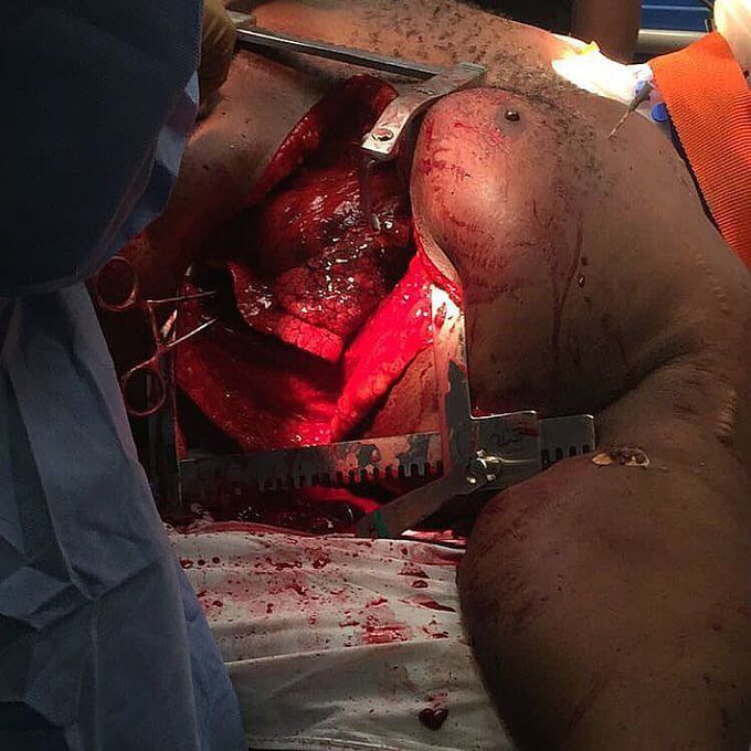 Left sided emergency thoracotomy following a cardiac arrest due to chest trauma!!