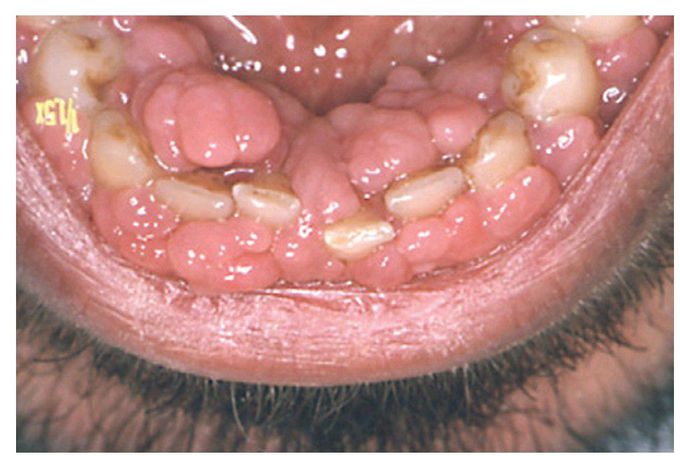 Cyclosporine induced gingival enlargement