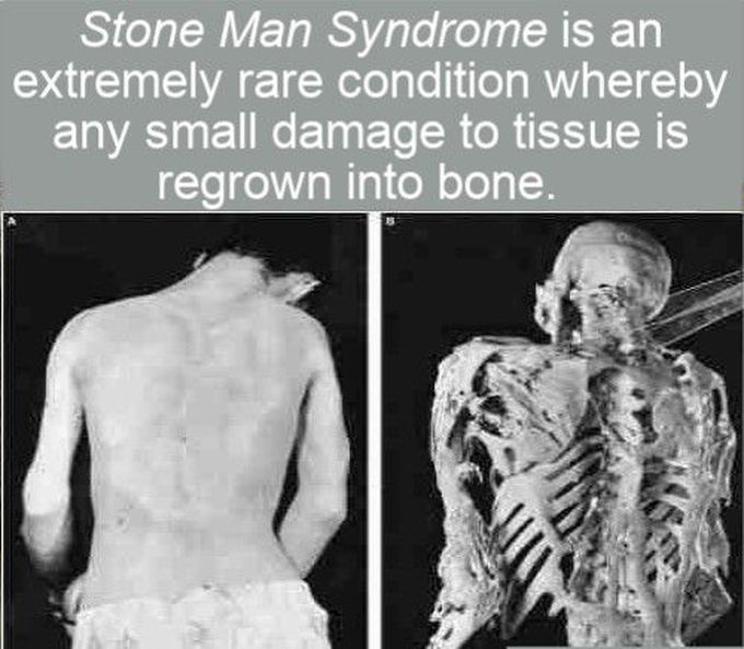 Stoneman Syndrome