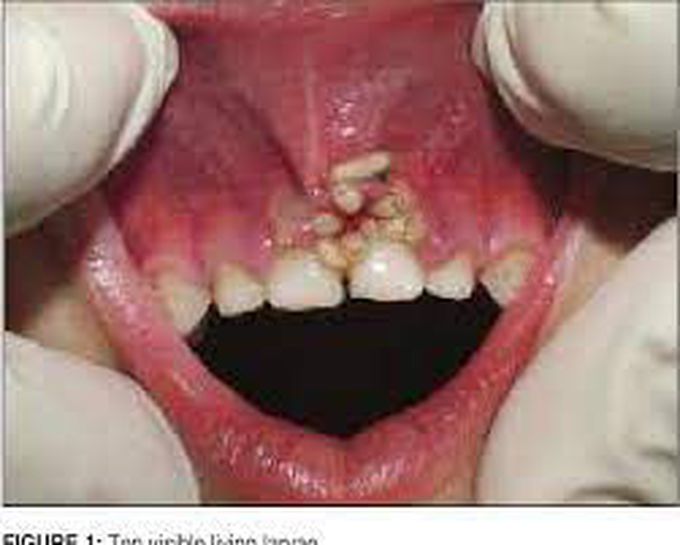 Signs of having worm/larvae in mouth