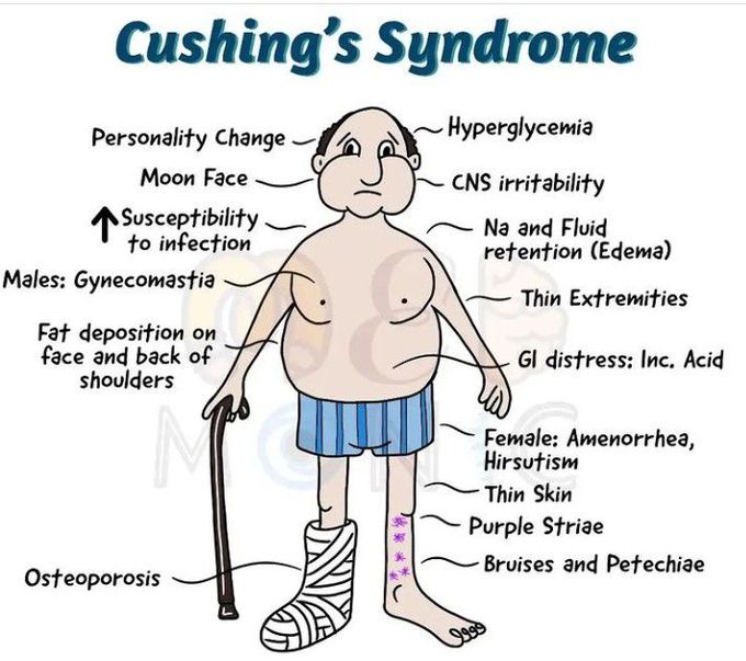 cushing-syndrome-medizzy