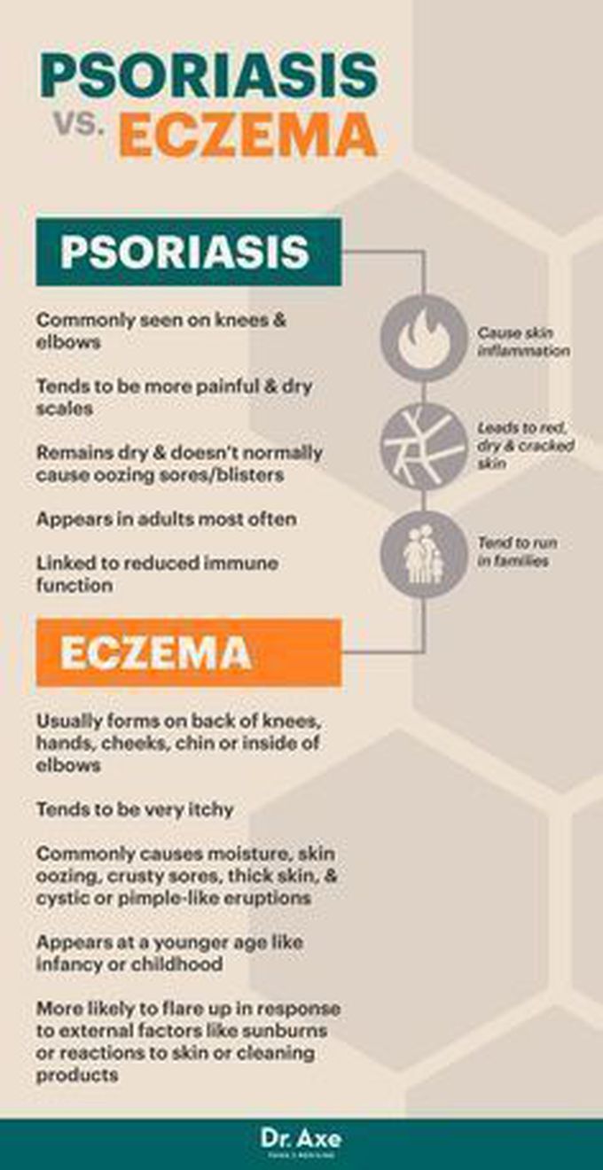 Psoriasis nd eczema