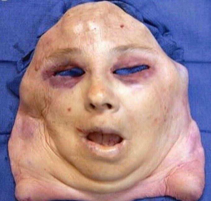 Donor face ready to be transplanted
