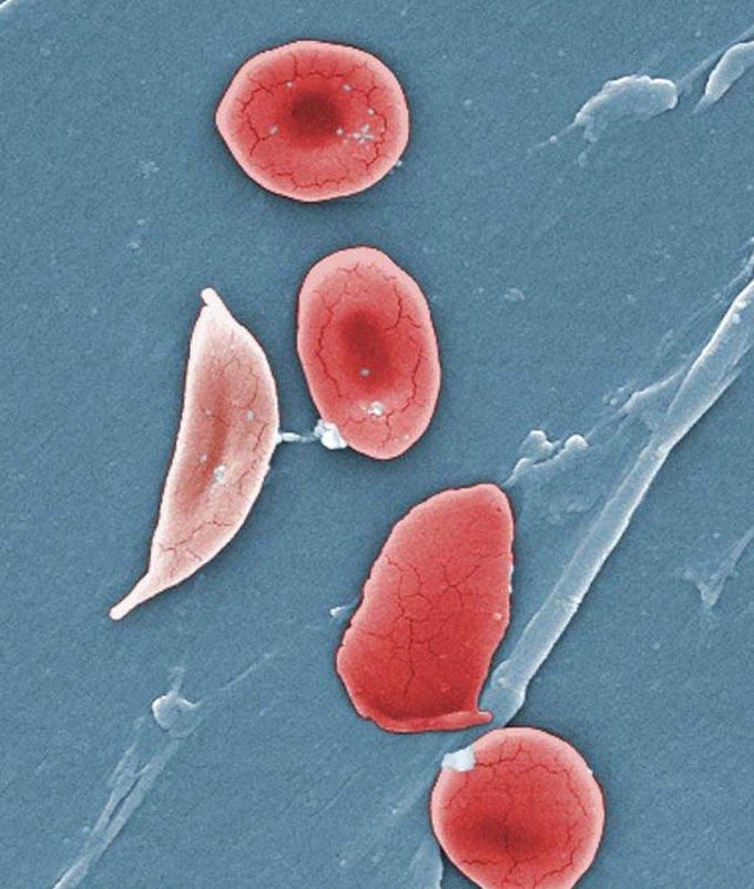 Sickle Cell with Normal RBC