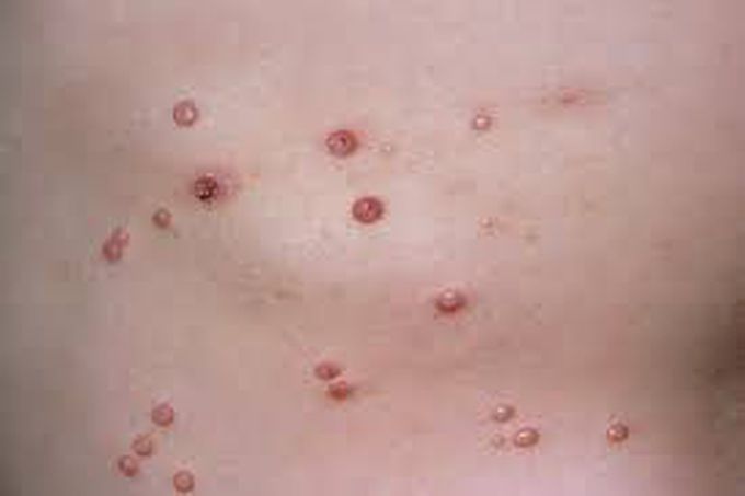 What are possible complications of molluscum contagiosum?
