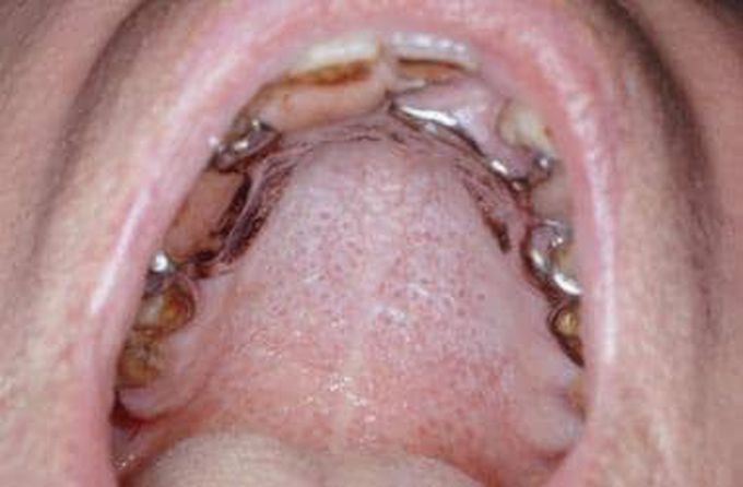 Nicotinic stomatitis