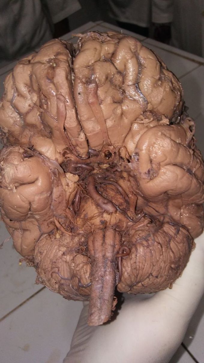 Brainstem