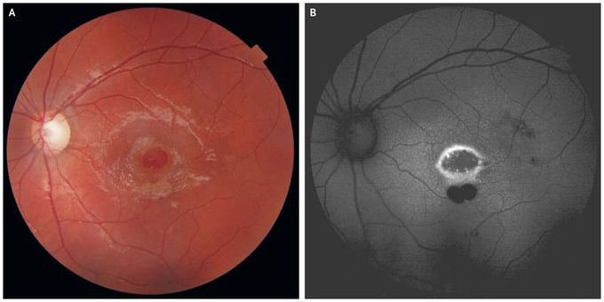 Macular Hole from a Laser Pointer