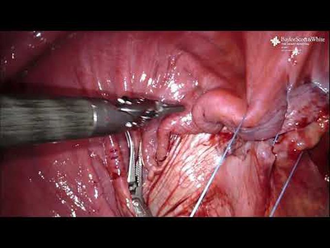 Robot-Assisted Plication of the Right Hemidiaphragm