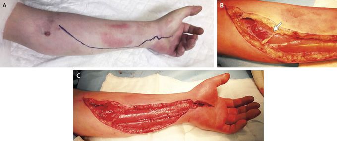 Compartment Syndrome