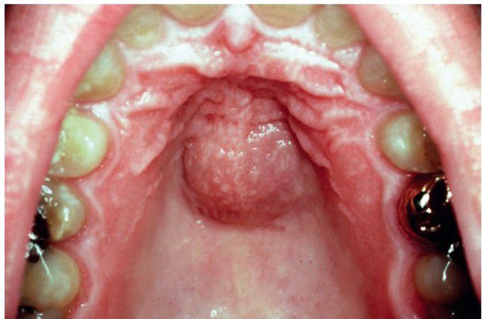 Median palatal cyst