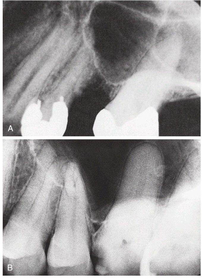 Maxillary sinus perforation