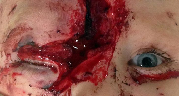 Lacrimal gland injury