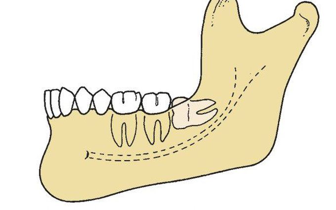 Difficult impaction case