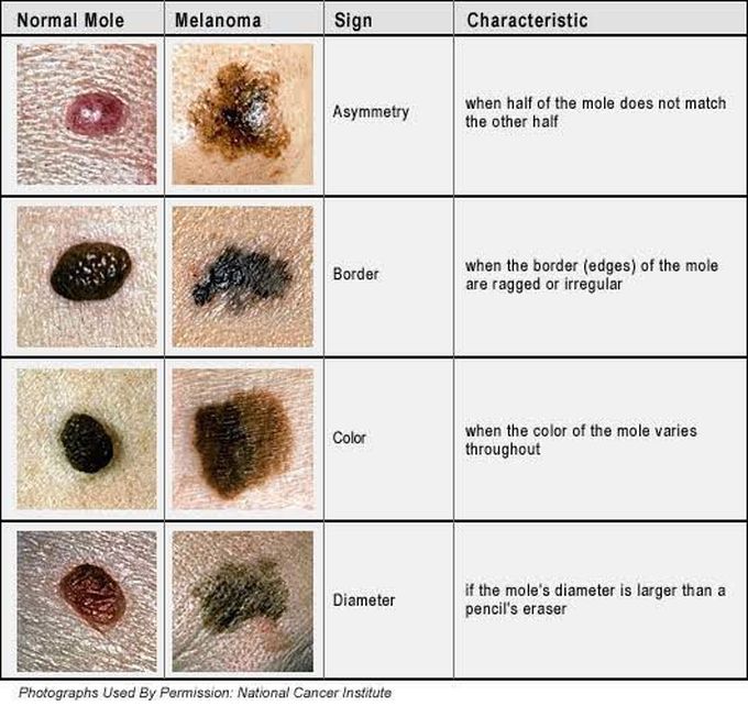 Difference between Normal mole and melanoma