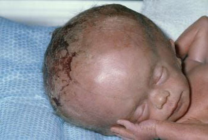 Symptoms of hydrocephalus