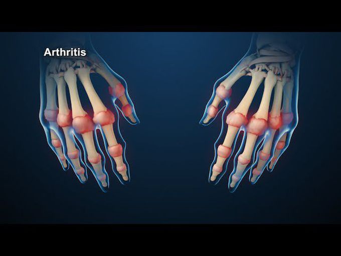 Rheumatoid Arthritis Animation