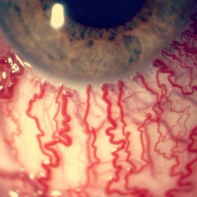 Stress can do this to your eyes!