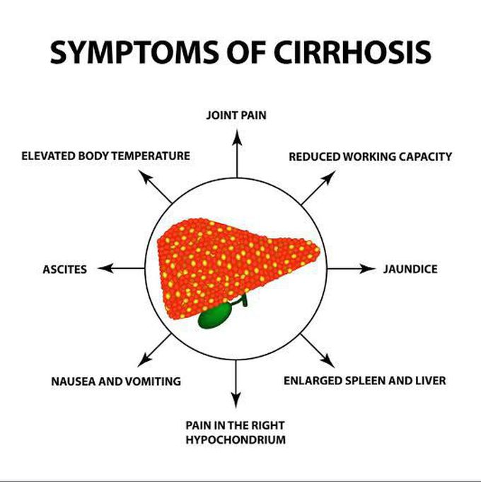 Symptoms of cirrhosis.
