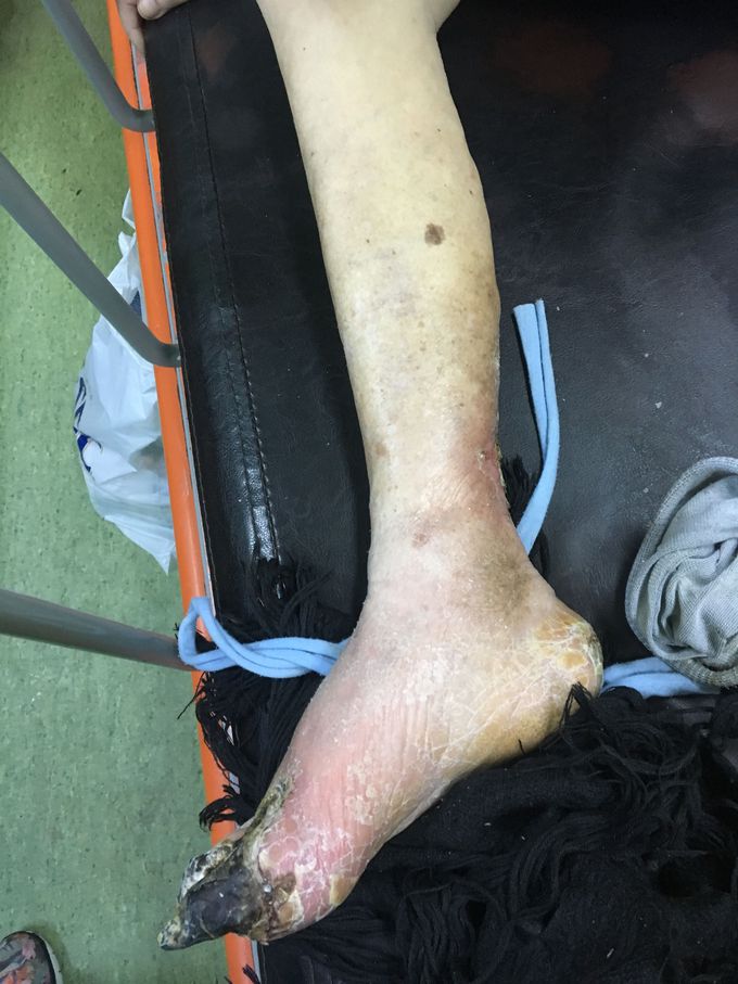 Gangrene