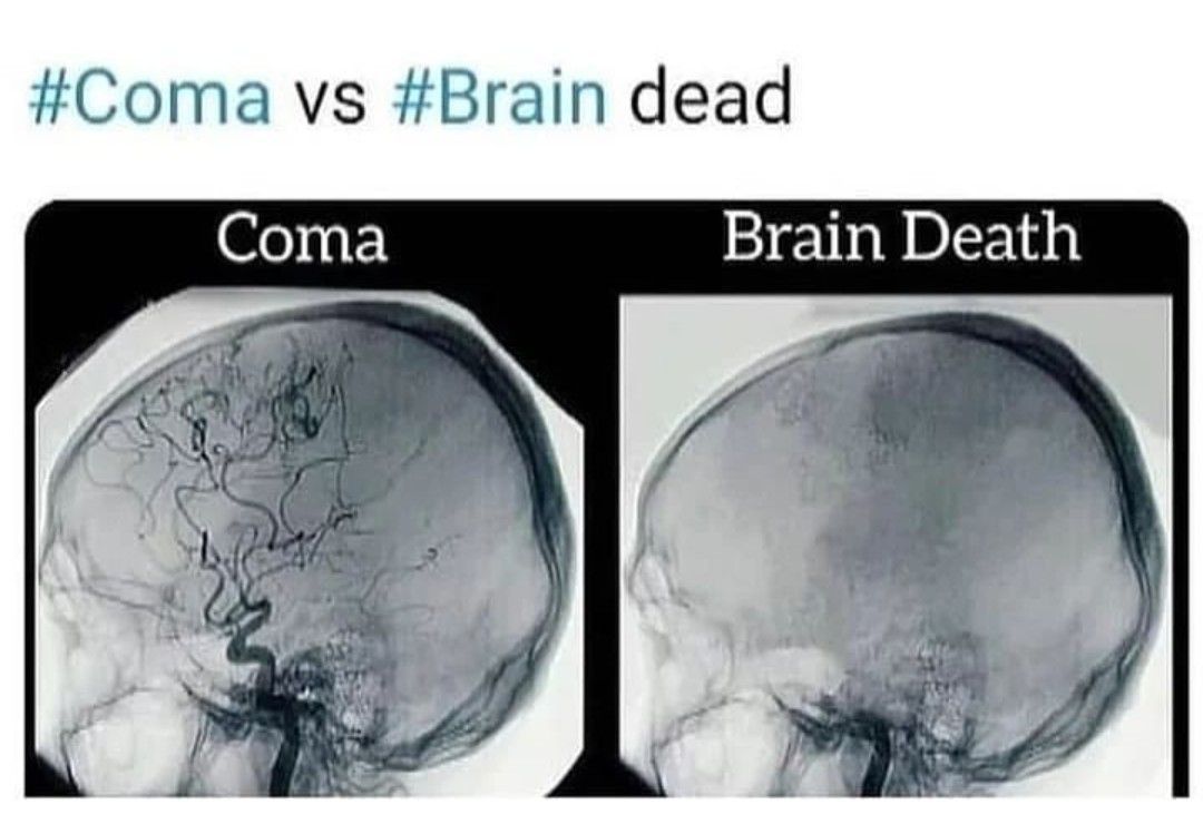 What is the Difference Between a Coma and Brain Death?