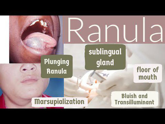 Ranula: Surgical Overview
