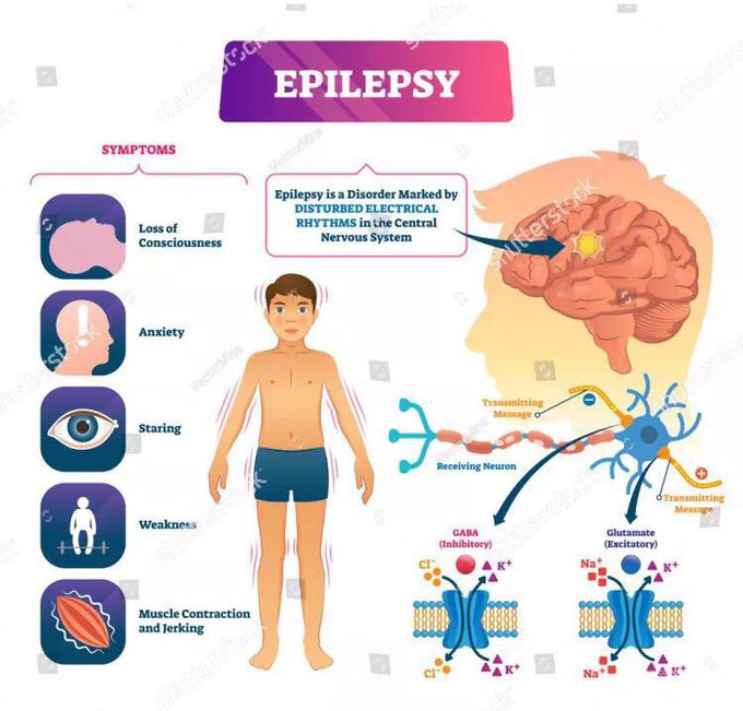 Epilepsy