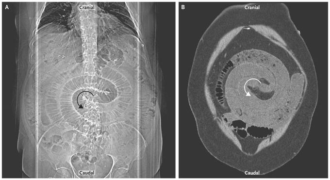 Swirl Sign — Intestinal Volvulus after Roux-en-Y Gastric Bypass