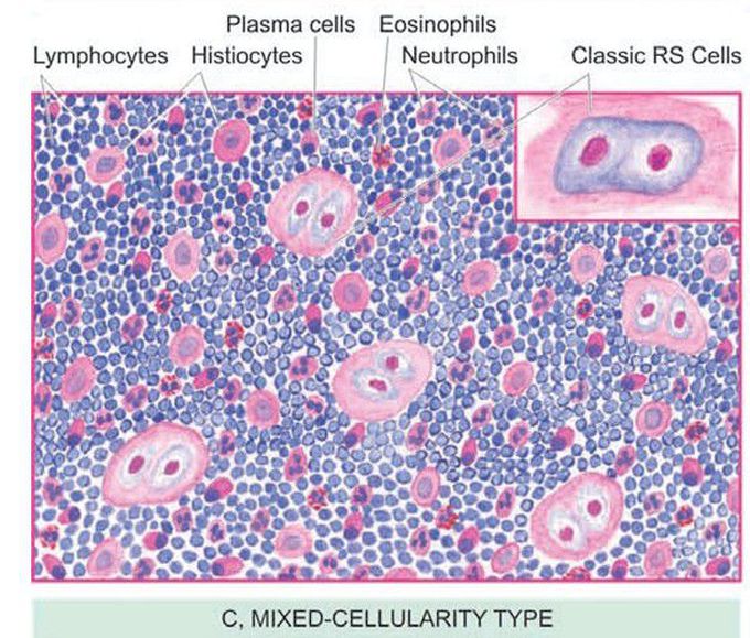 Mixed cellularity type(hodgekin's lymphoma)