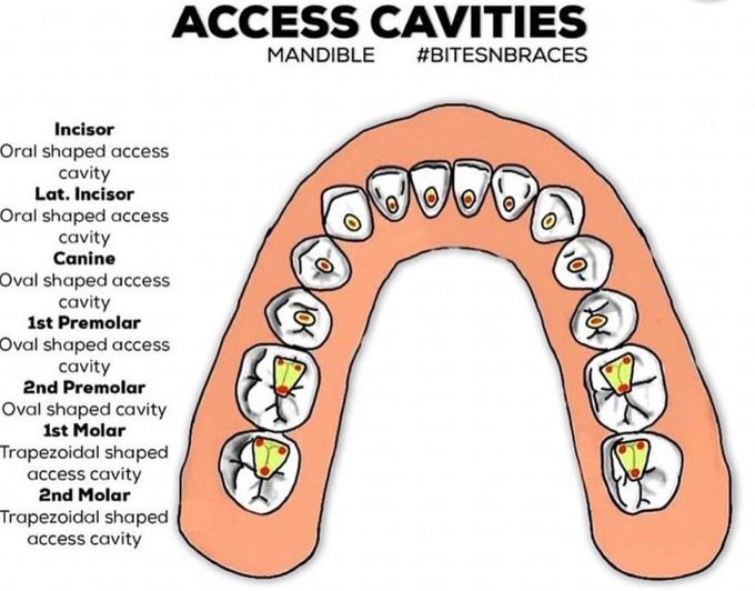 Access Cavity- Mandible