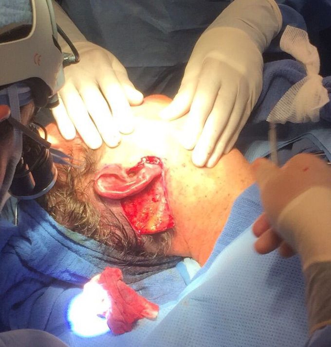 Necklift first incision