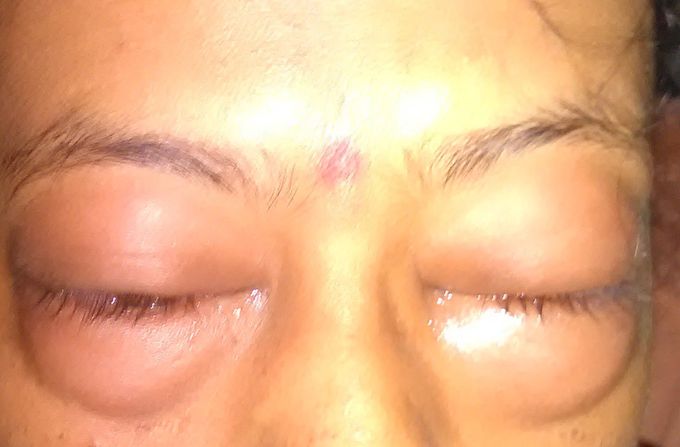 Medical emergency:- swellings like above shown, occurs after intramuscular injection of drugs like diclofenac , etc .   But it does not occurs in intravenous injection. Edematous allergic inflammation leads to terrifying feel of ocular pressure. And citrazine tablets fails to reduce swellings