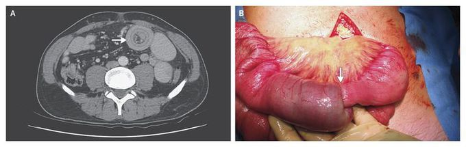 Enteroenteric Intussusception