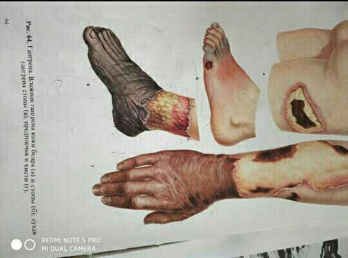 Dry gangrene