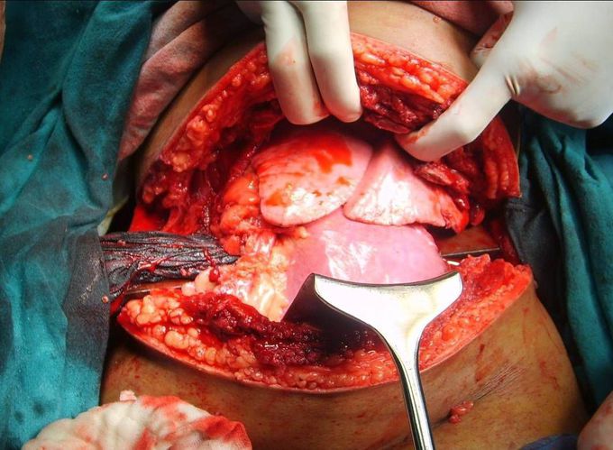Amazing case of abdominothoracic trauma due to impalement by an iron bar