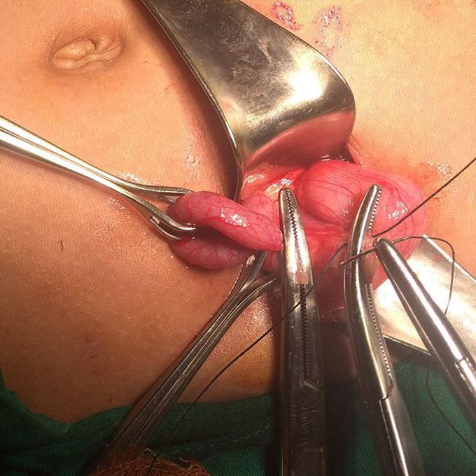 11 y.o girl with chief complain pain in RLQ abdomen, Samuel Score was 9. Appendectomy chosen as therapy. 