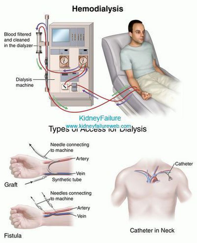 Hemo Dialysis