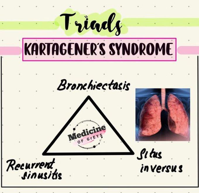 Kartagener's syndrome