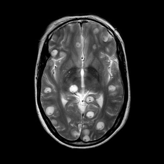 Neurocysticercosis