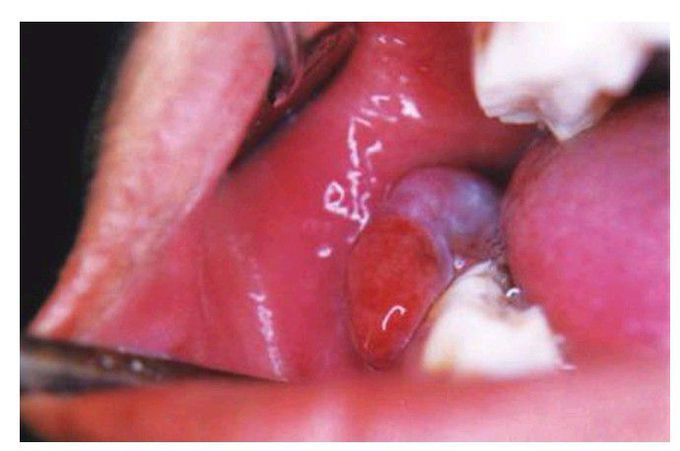 Peripheral giant cell granuloma