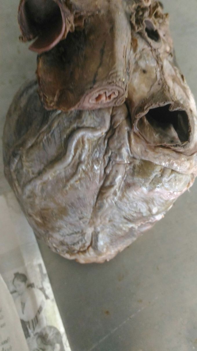 Human heart