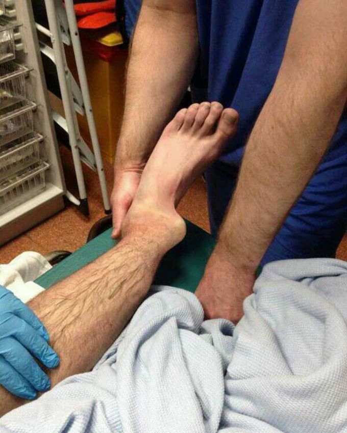Severely dislocated ankle as a result of a football accident! 
